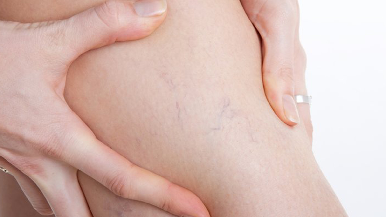 uzmani acikladi varis hastalari sicaklarda nelere dikkat etmeli neRHmYqj